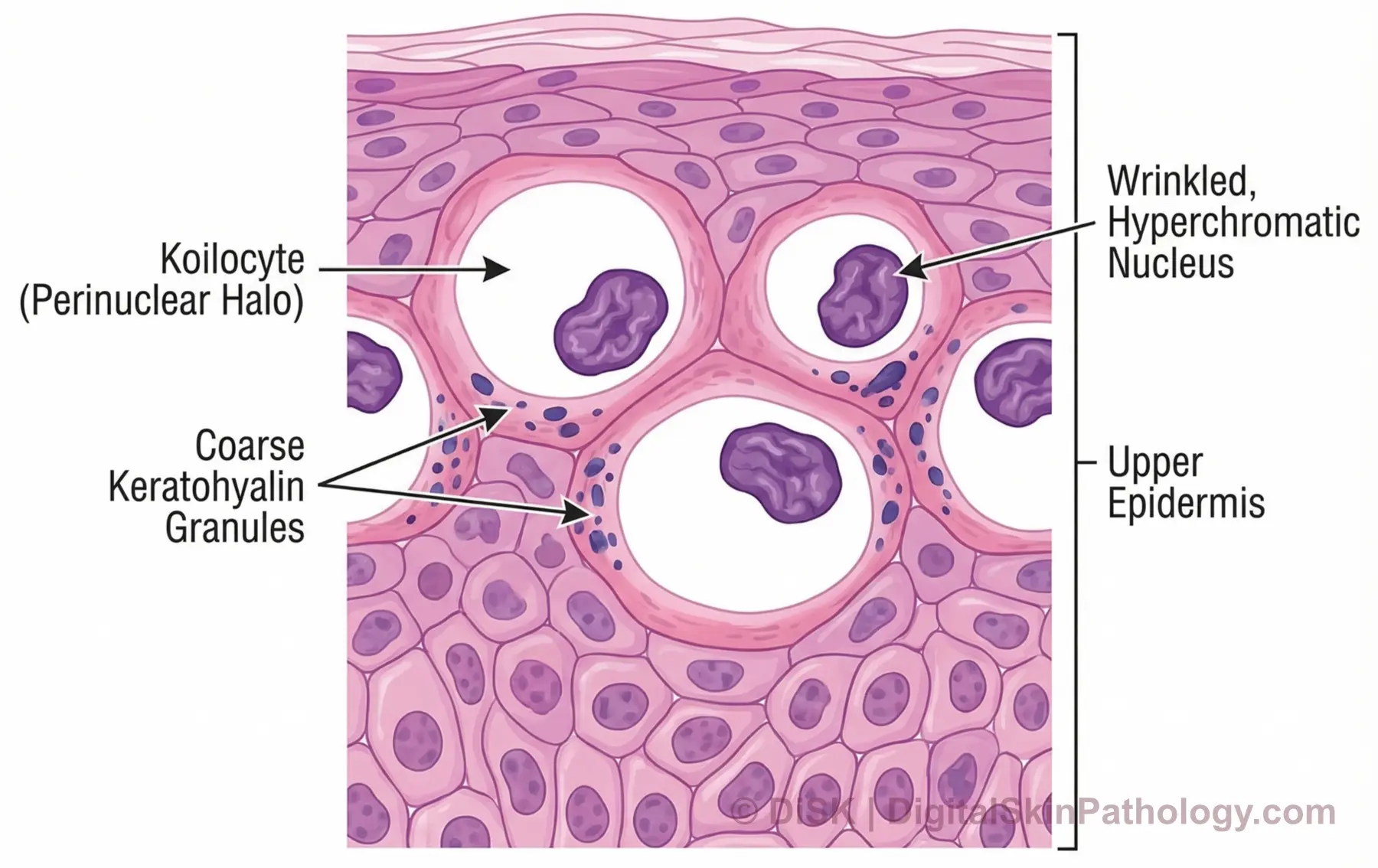 Koilocyte thumbnail