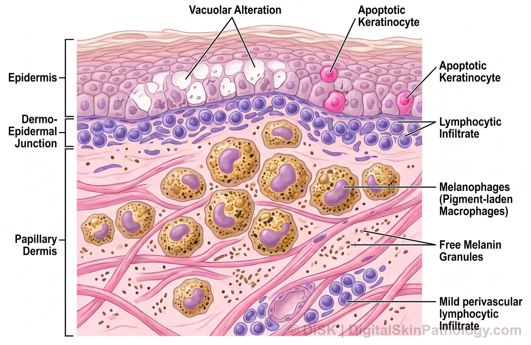 Pigment Incontinence thumbnail