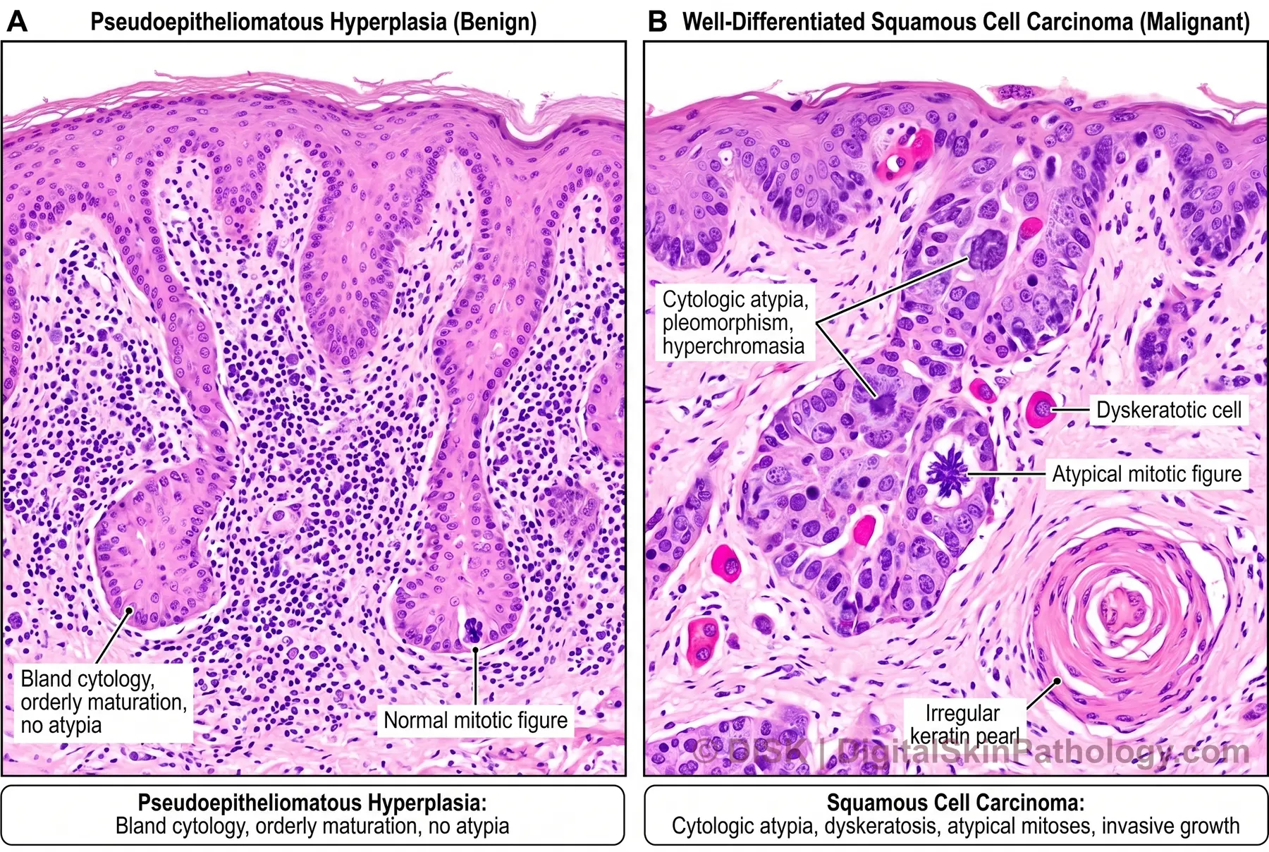 Pseudoepitheliomatous Hyperplasia (PEH) thumbnail