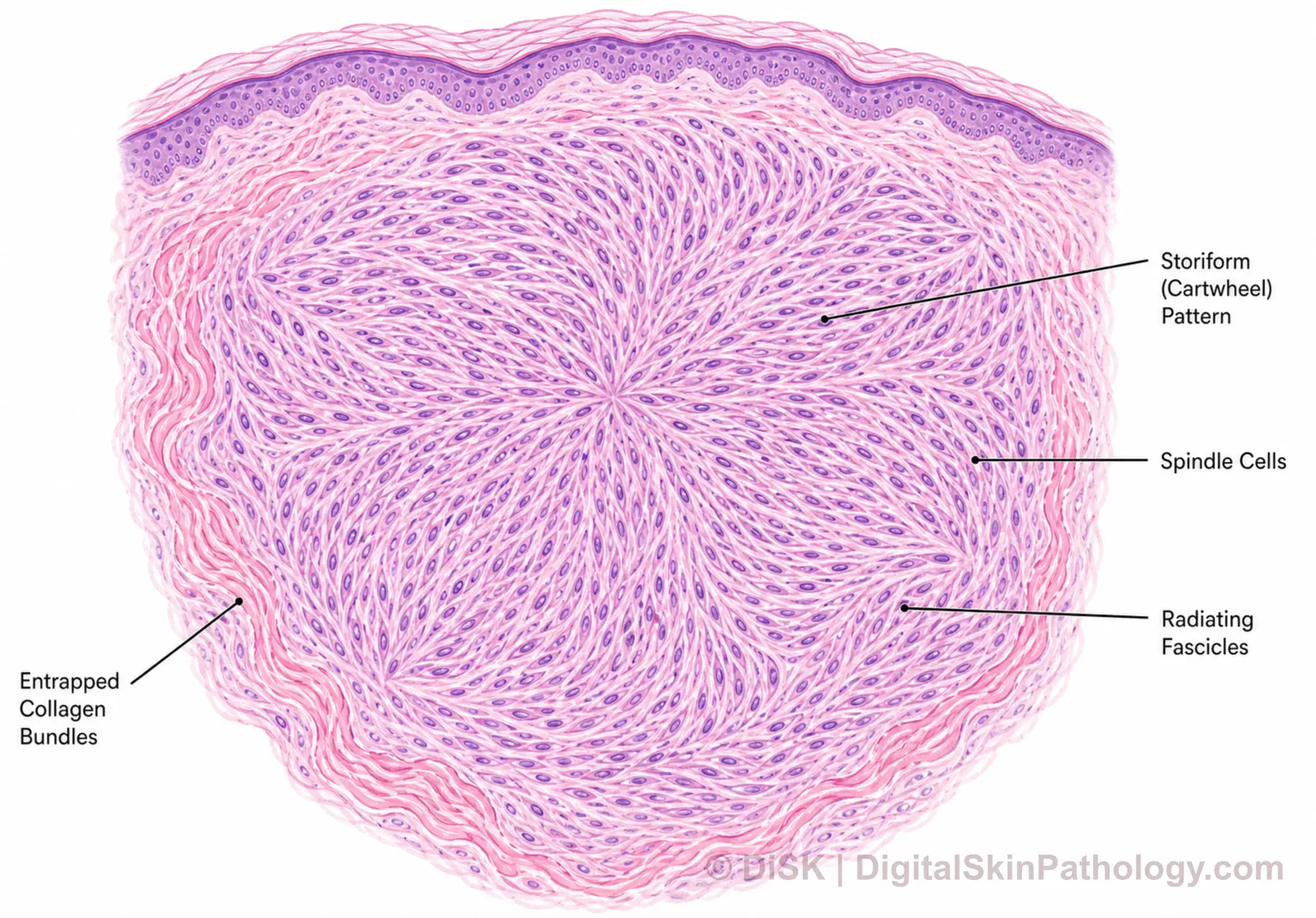 Storiform Pattern thumbnail