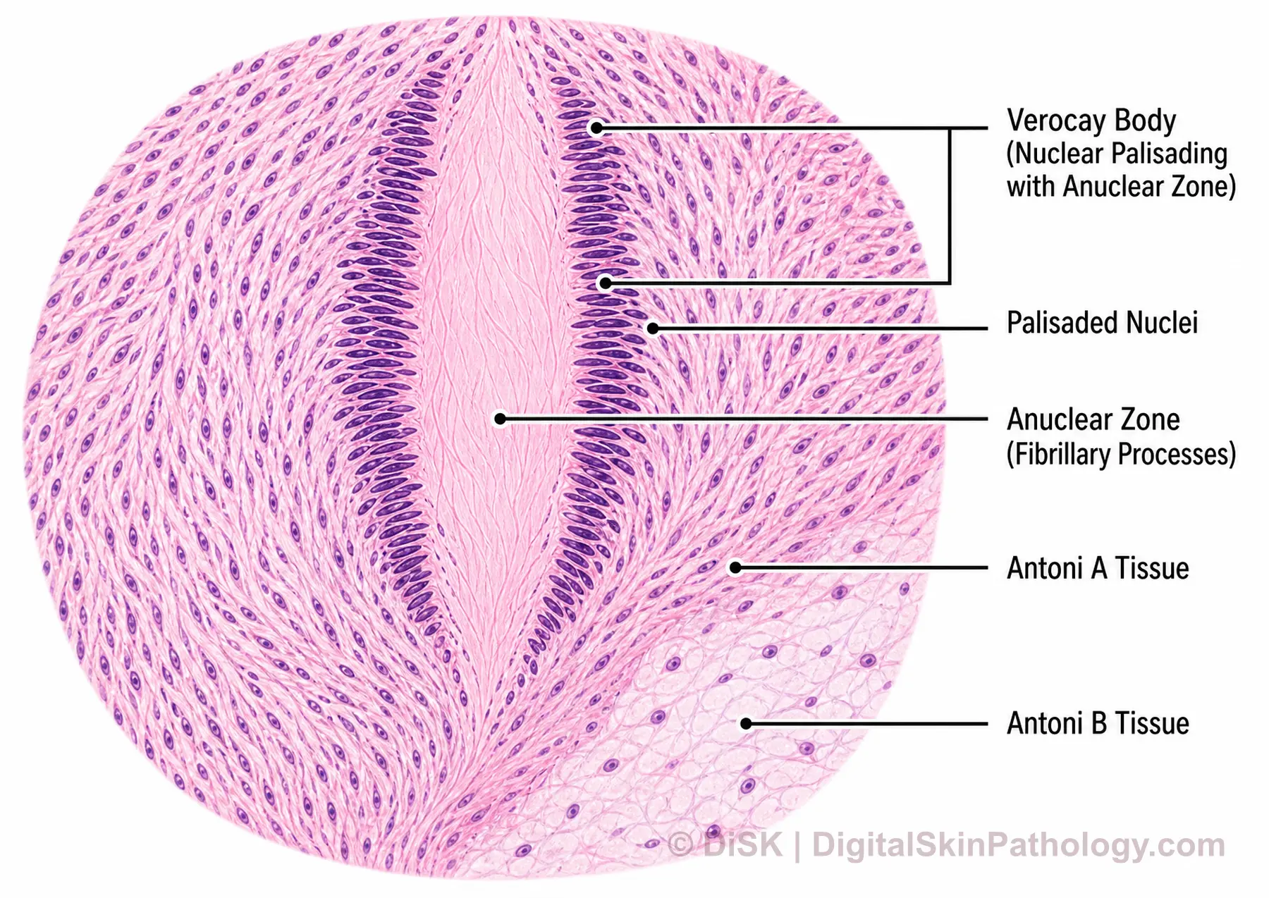 Verocay Body thumbnail